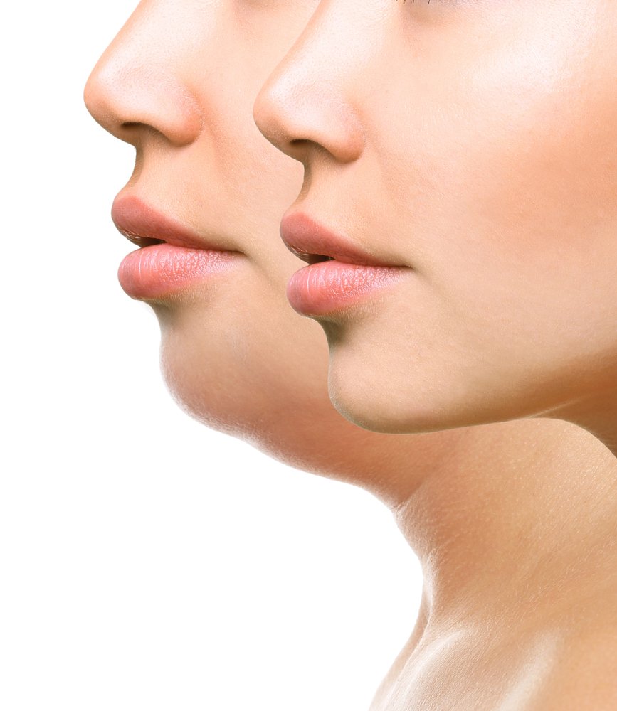 OLIGIO 17 park-aesthetics_double chin reduction