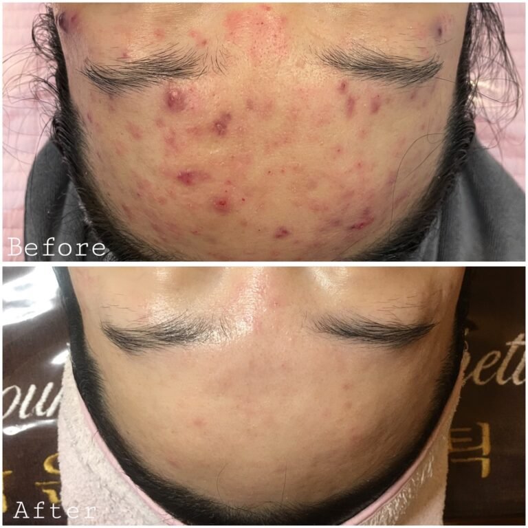 Acne Before & After