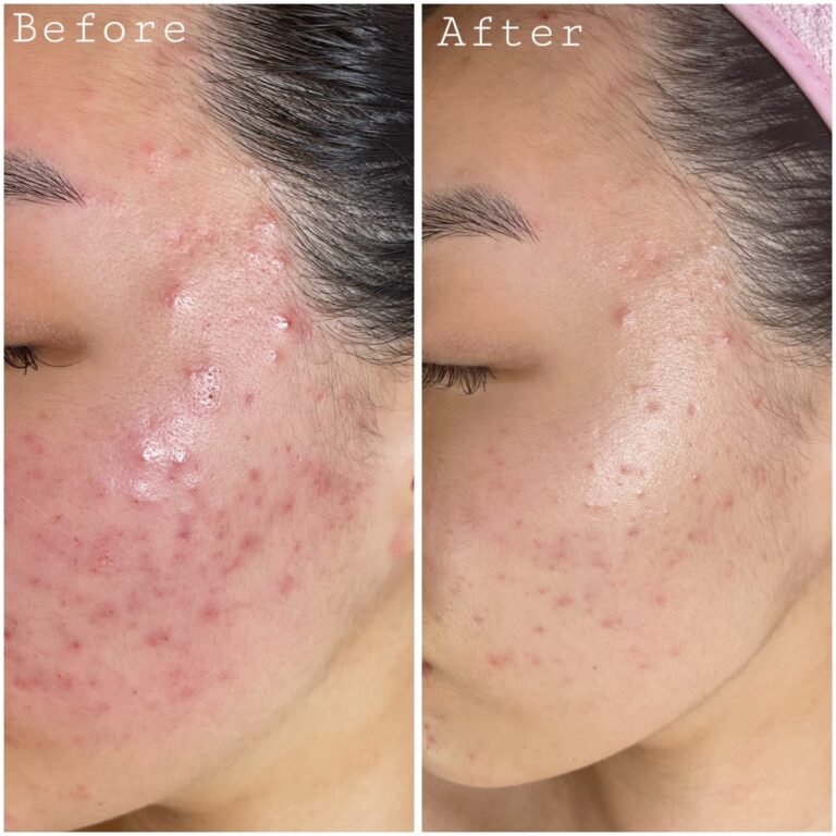 Acne Before & After