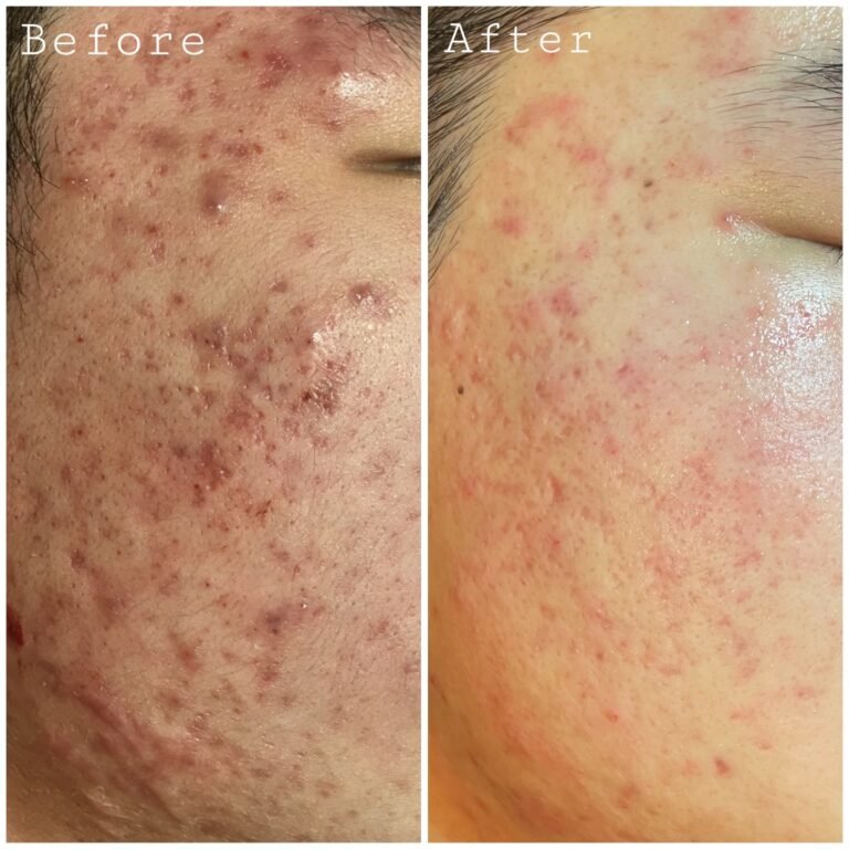 Acne Before & After