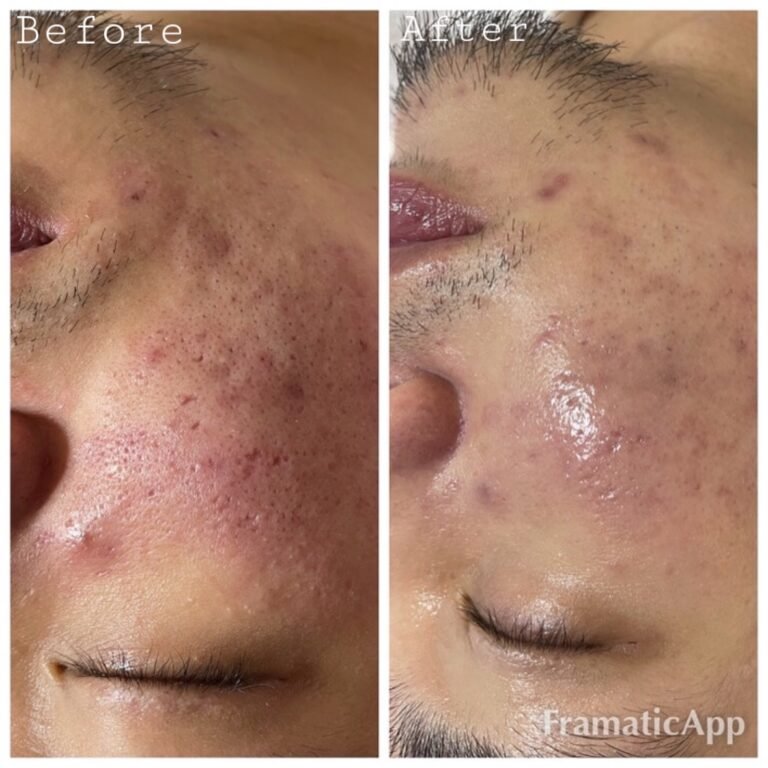 Acne Before & After