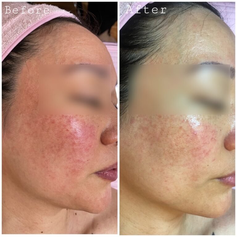 Sensitive skin Before & After