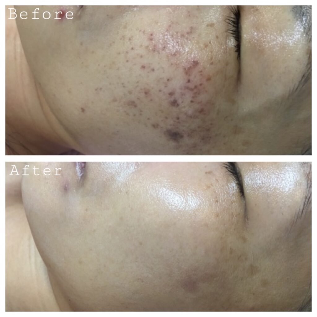 Laser treatment Before & After