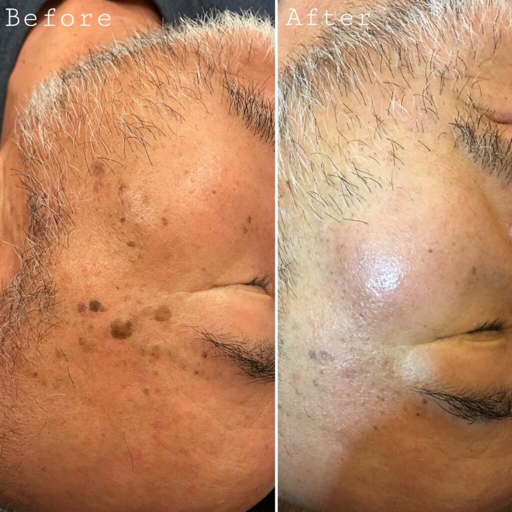Laser treatment Before & After