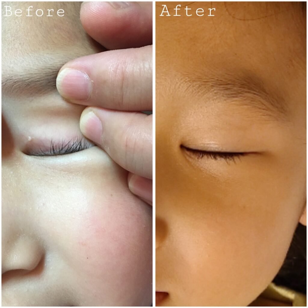 Laser treatment Before & After