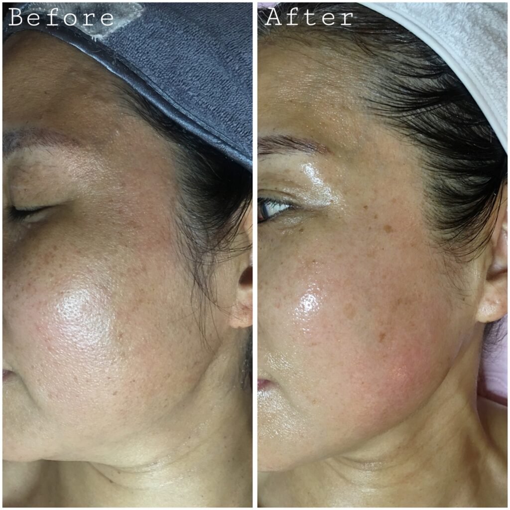 Laser treatment Before & After