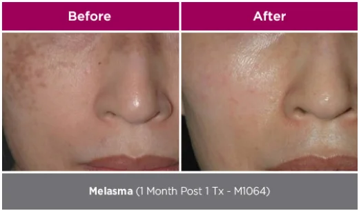 Curas + Genesis Facial 15 park-aesthetics_W1 3