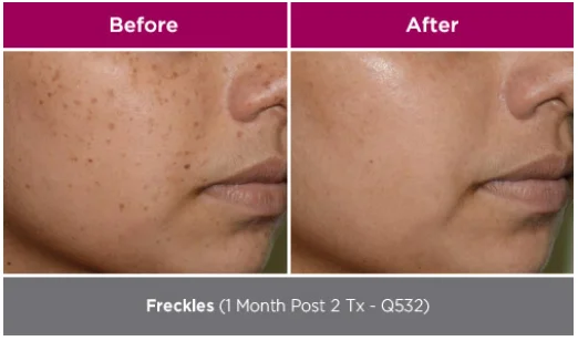 Curas + Genesis Facial 16 park-aesthetics_W3 1