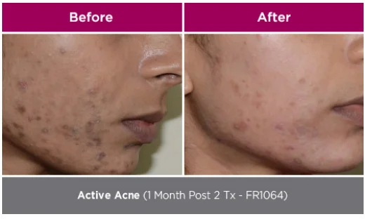 Curas + Genesis Facial 17 park-aesthetics_W4 2