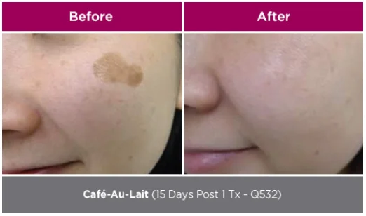 Curas + Genesis Facial 18 park-aesthetics_W5 1